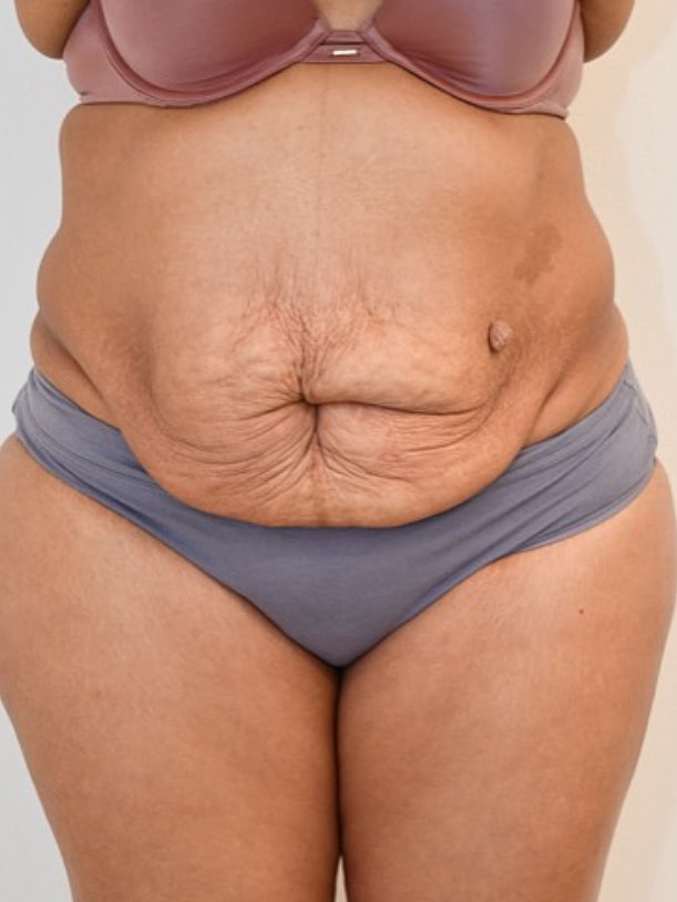 Tummy Tuck before and after - before