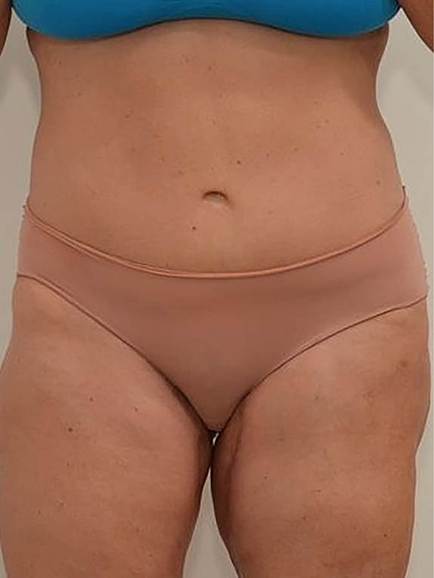 Tummy Tuck before and after - after