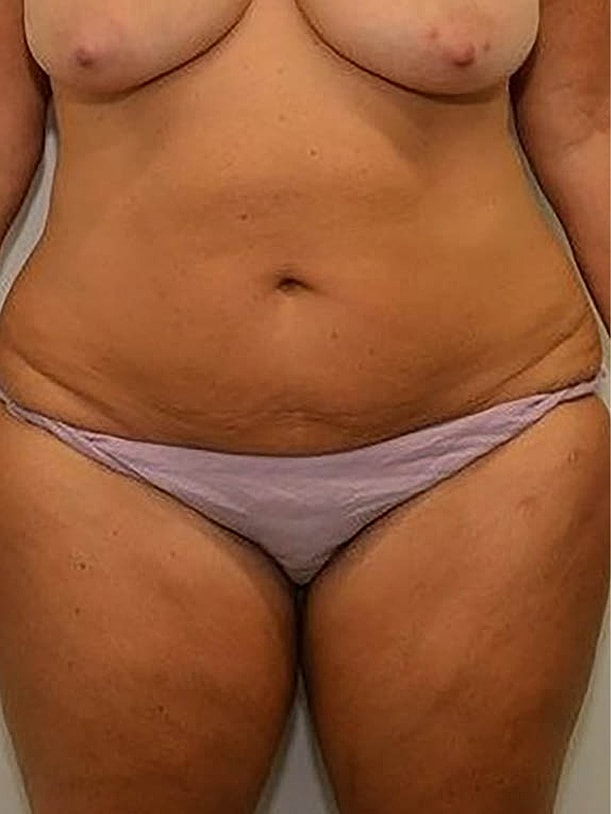 Tummy Tuck before and after - before