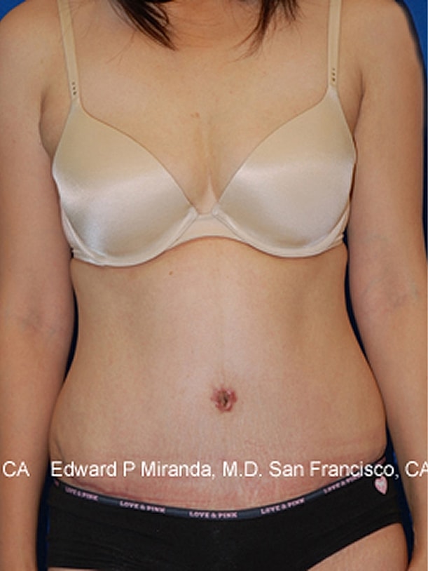 Tummy Tuck before and after - after