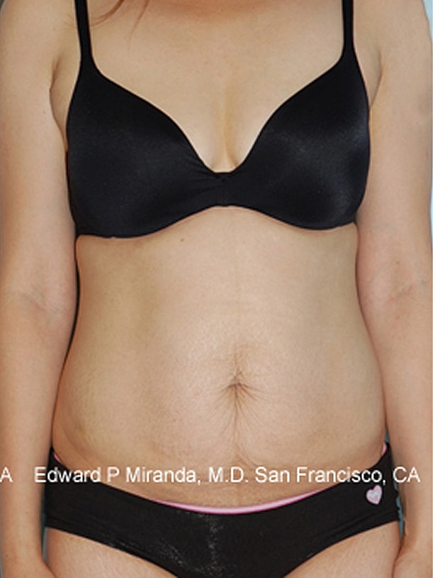 Tummy Tuck before and after - before