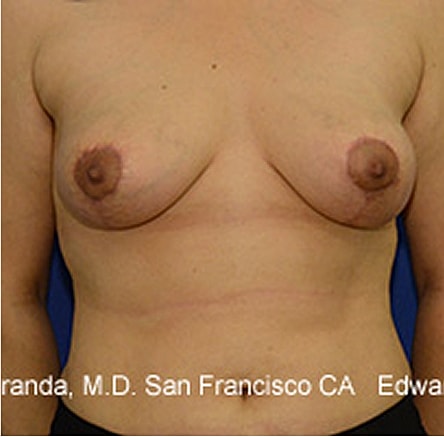 Breast Lift after — Dr. Edward Miranda