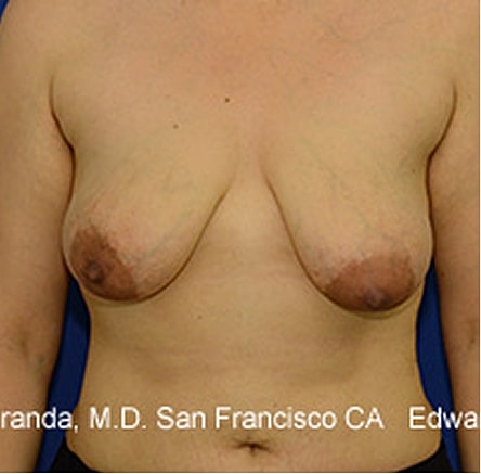 Breast Lift before — Dr. Edward Miranda