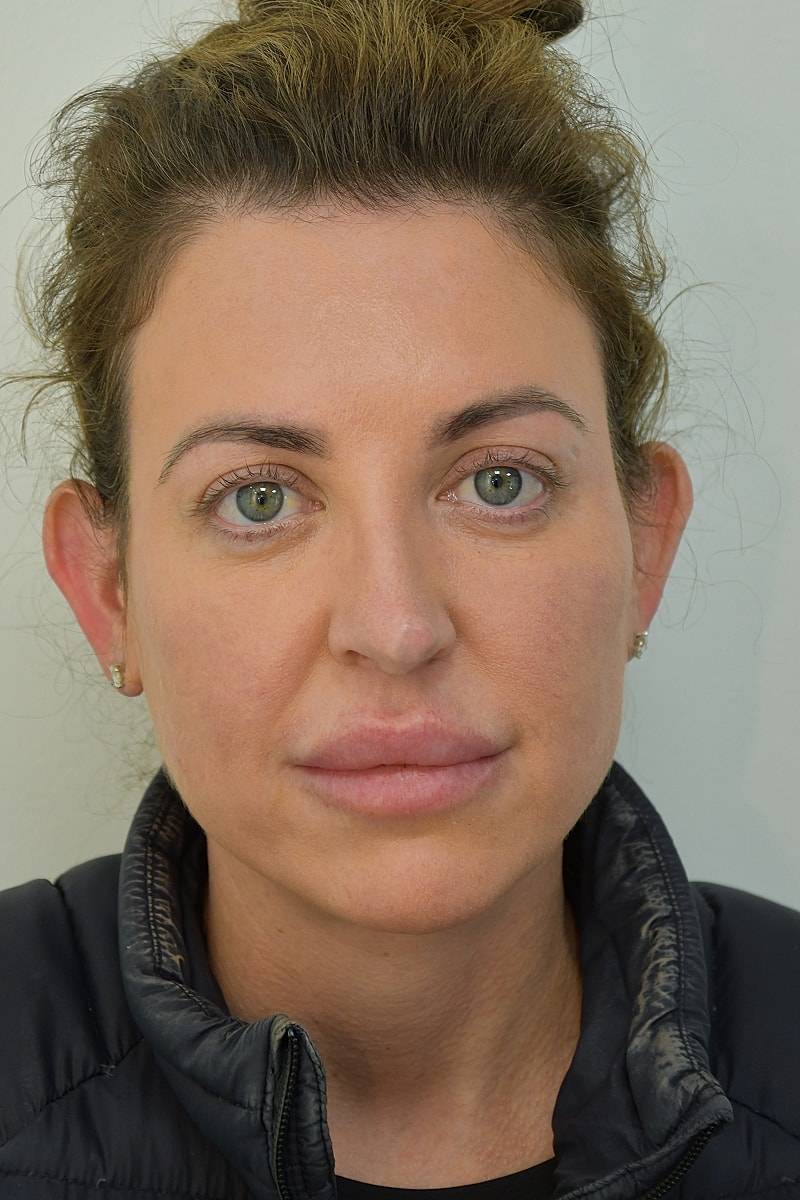 Brow Lift after — Dr. Edward Miranda
