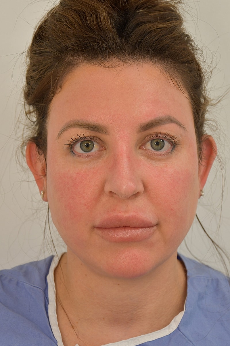 Brow Lift before — Dr. Edward Miranda