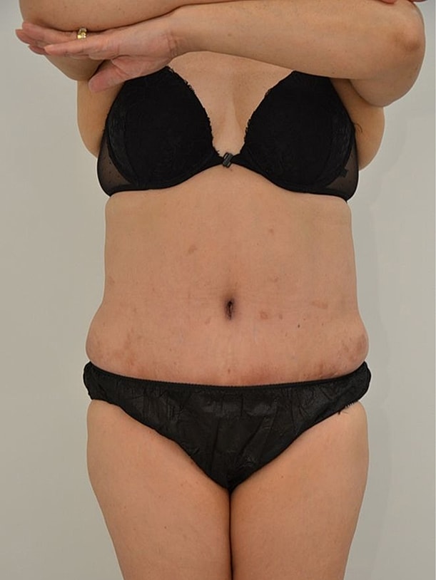 Tummy Tuck before and after - after