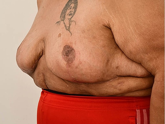 Breast Reduction before and after - after