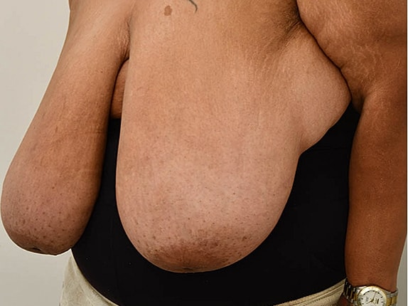 Breast Reduction before and after - before