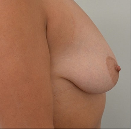 Breast Lift before and after - before