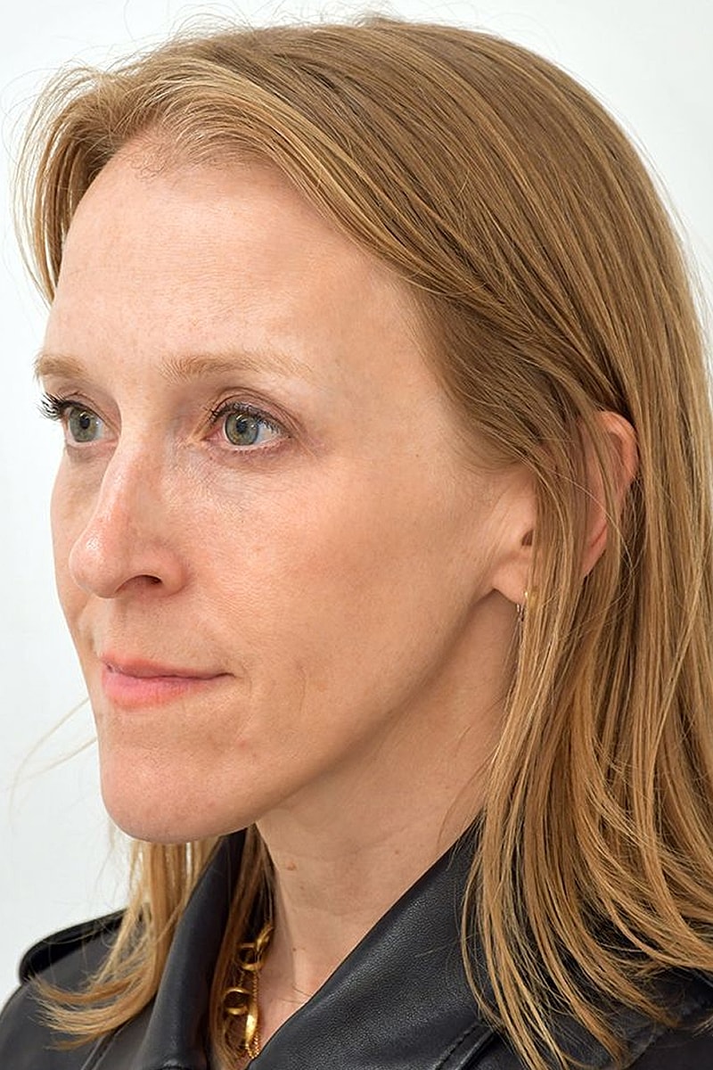 Brow Lift after — Dr. Edward Miranda