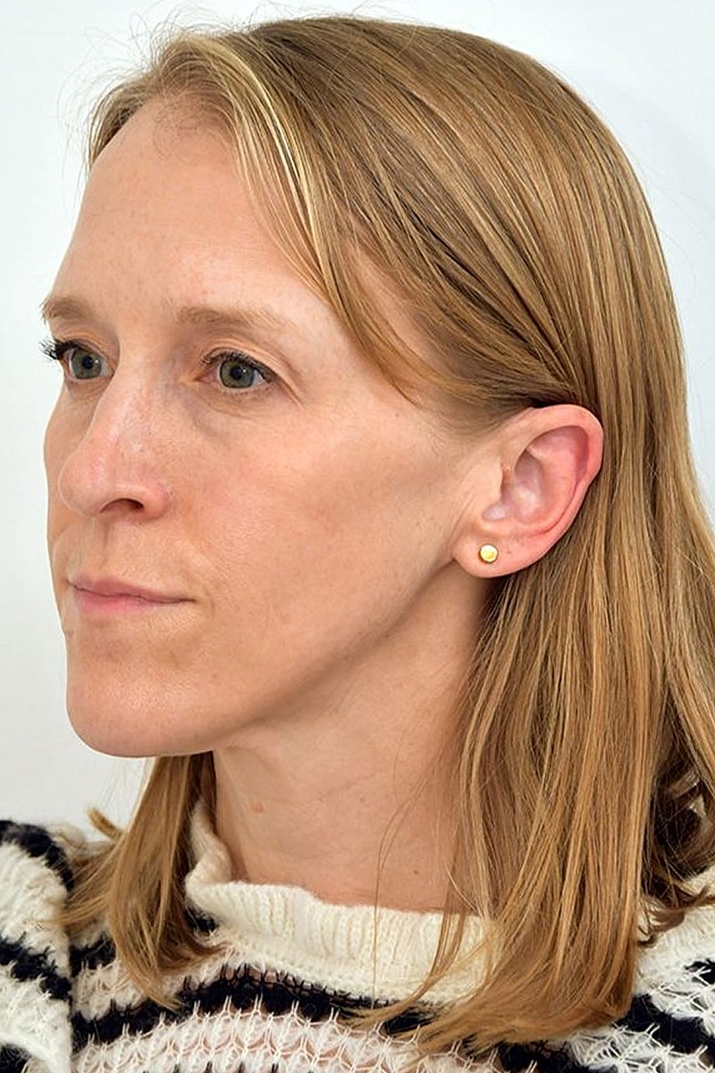 Brow Lift before — Dr. Edward Miranda