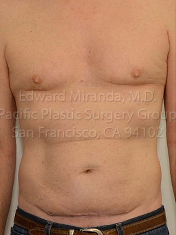 Tummy Tuck before and after - after