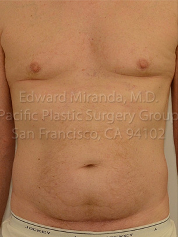 Tummy Tuck before and after - before