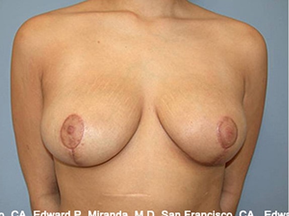 Breast Reduction before and after - after