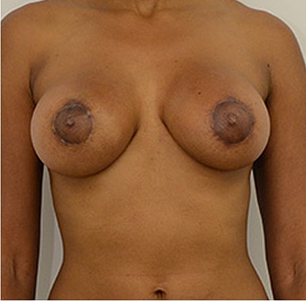 Breast Lift after — Dr. Edward Miranda