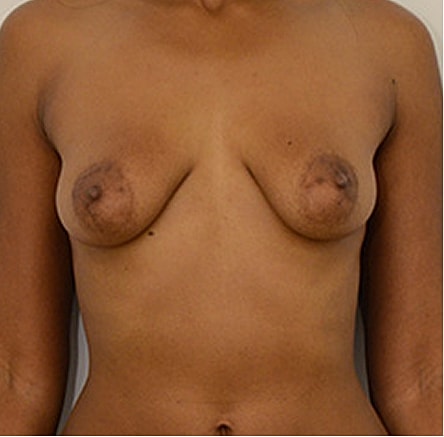 Breast Lift before — Dr. Edward Miranda