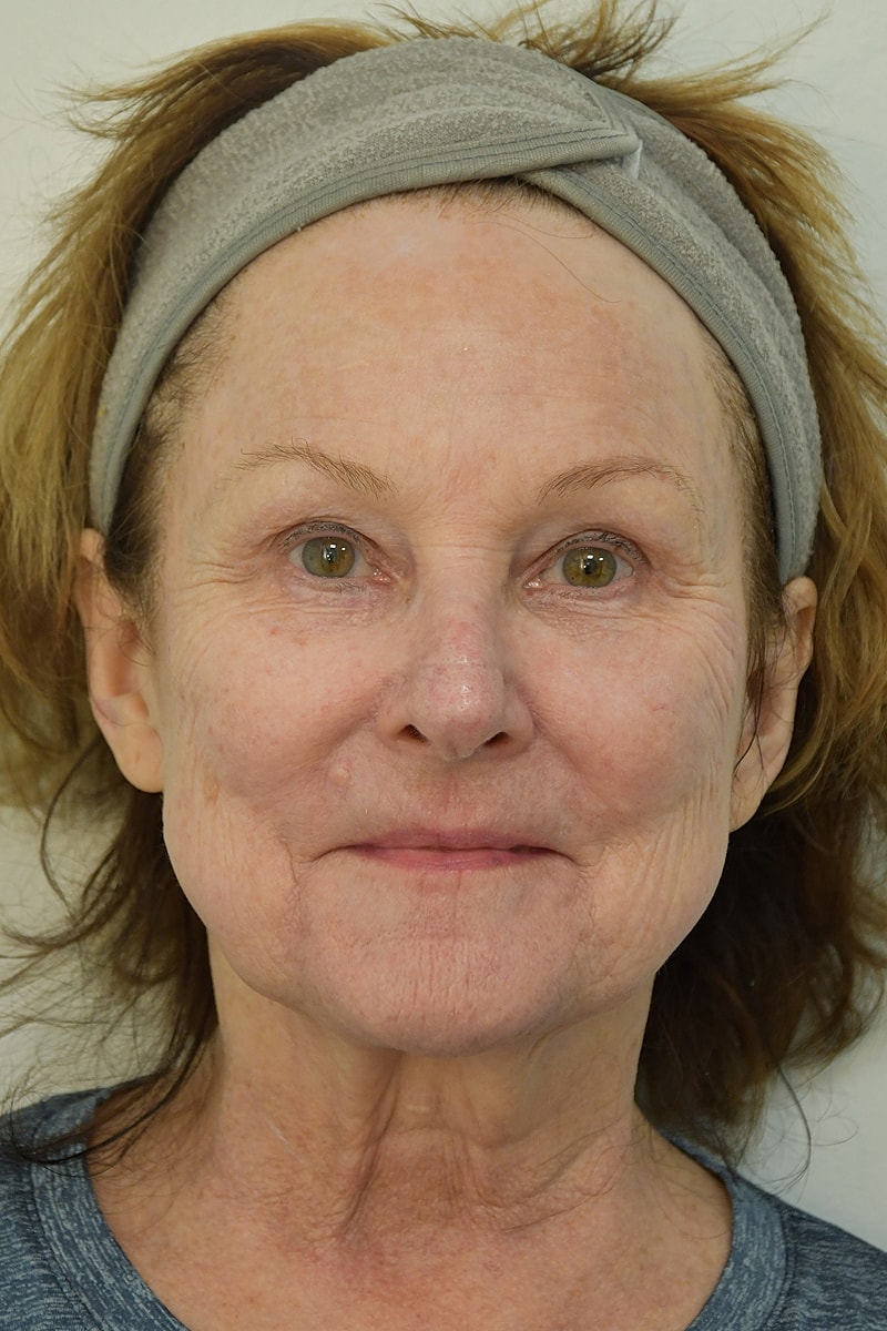 Brow Lift after — Dr. Edward Miranda