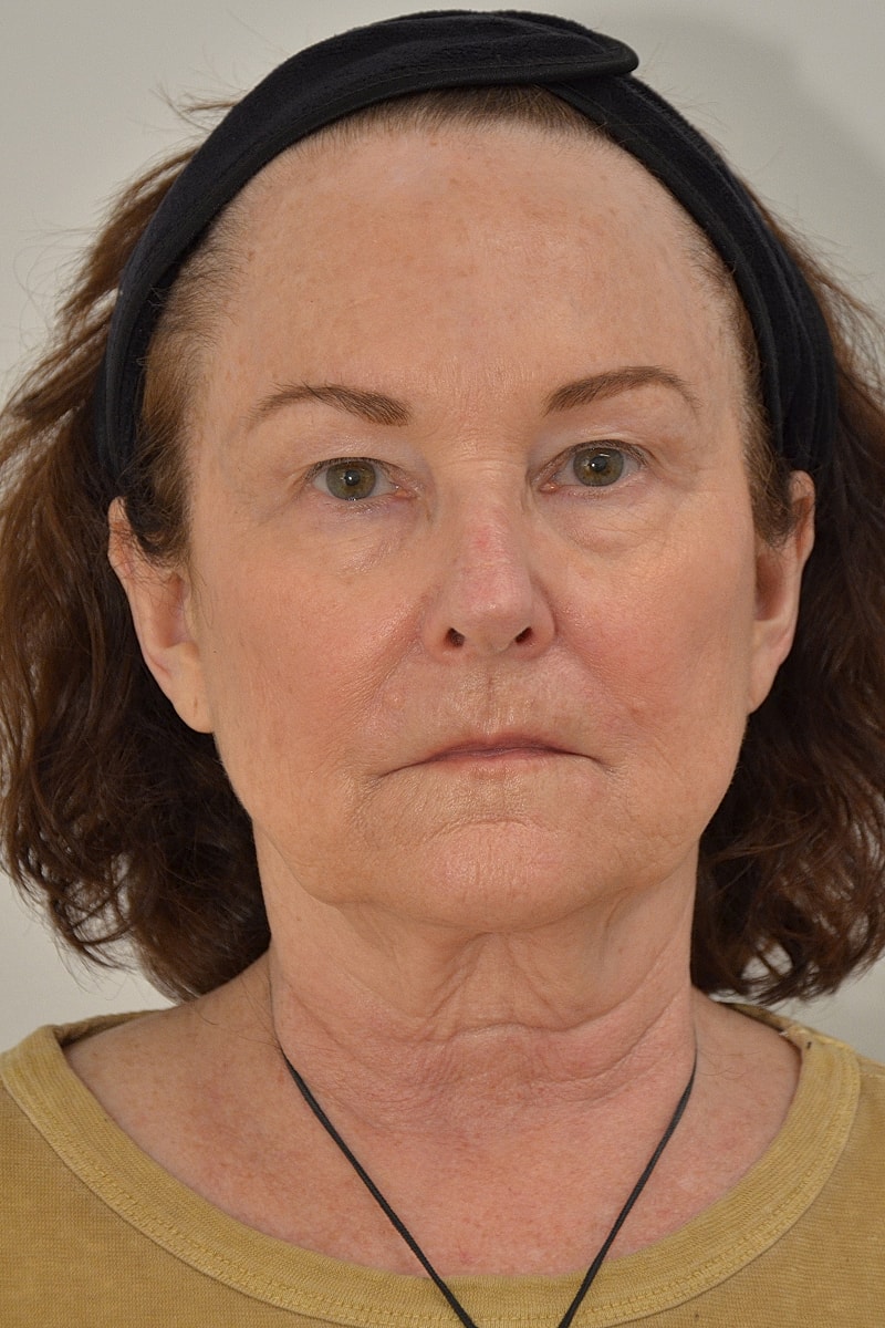 Brow Lift before — Dr. Edward Miranda