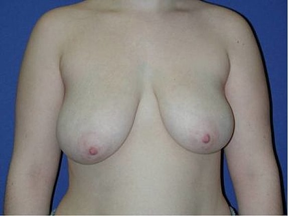 Breast Reduction before and after - before