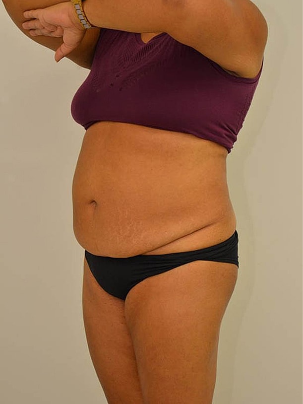 Tummy Tuck before and after - before