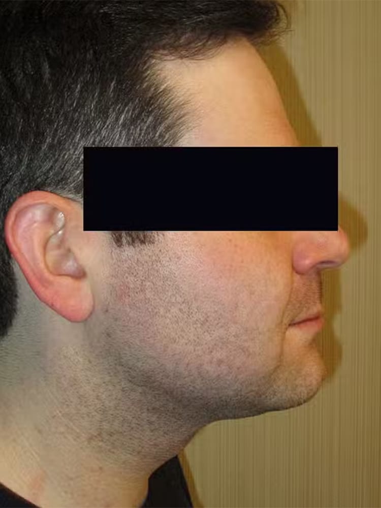 Liposuction/SmartLipo before and after - after