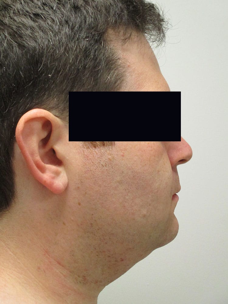 Liposuction/SmartLipo before and after - before