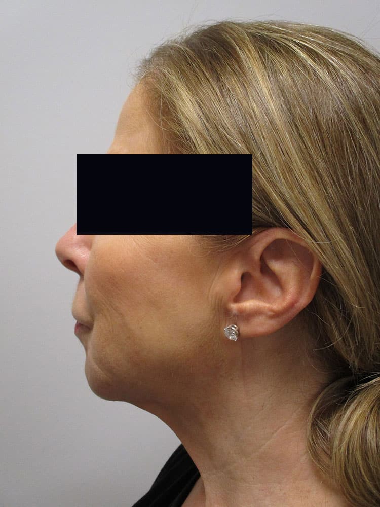 Liposuction/SmartLipo before and after - after
