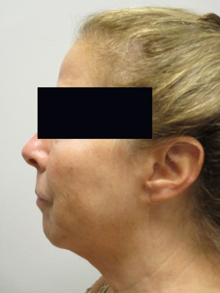 Liposuction/SmartLipo before and after - before