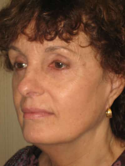Facelift before and after - after