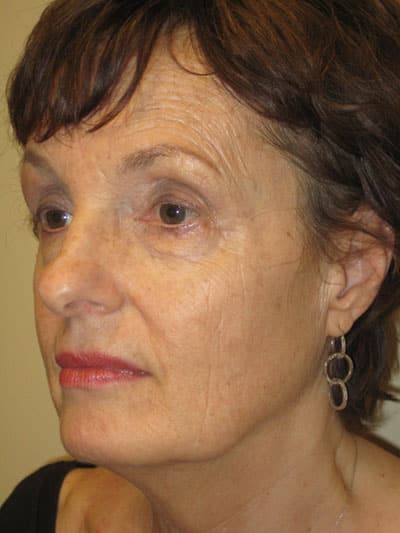 Facelift before and after - before