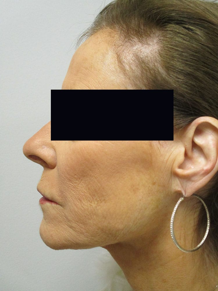 Liposuction/SmartLipo before and after - after