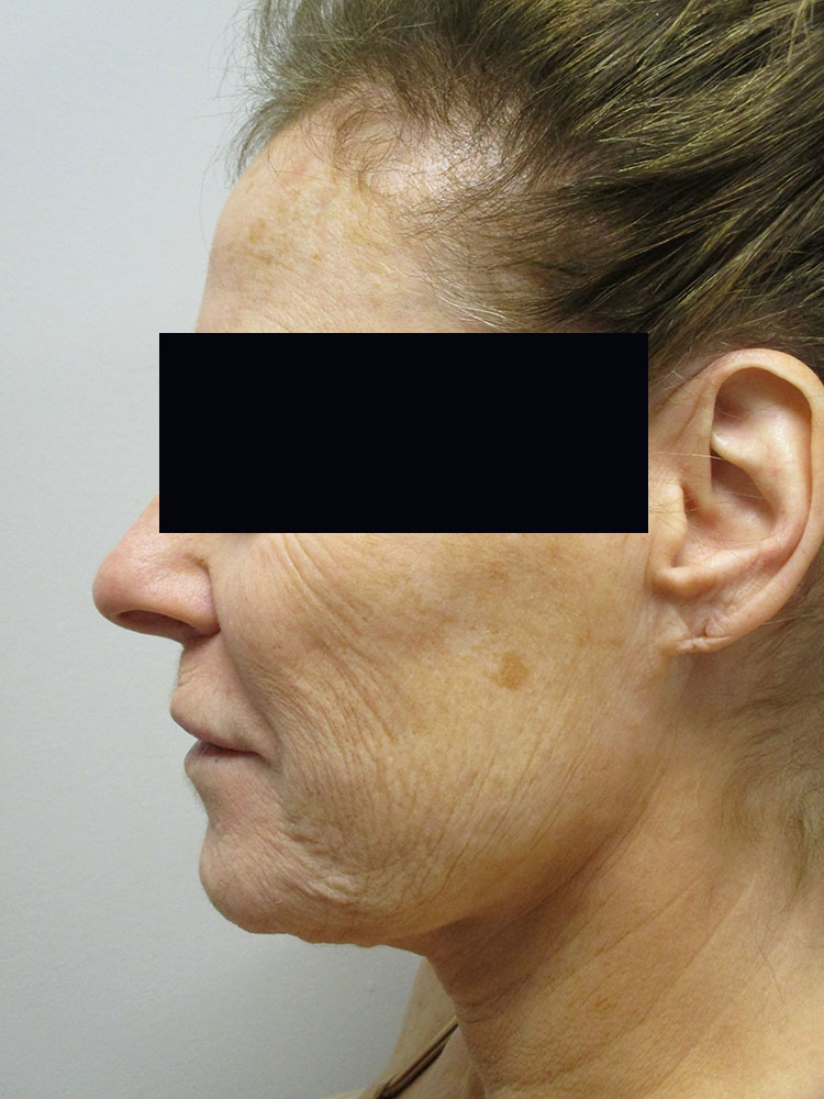 Liposuction/SmartLipo before and after - before