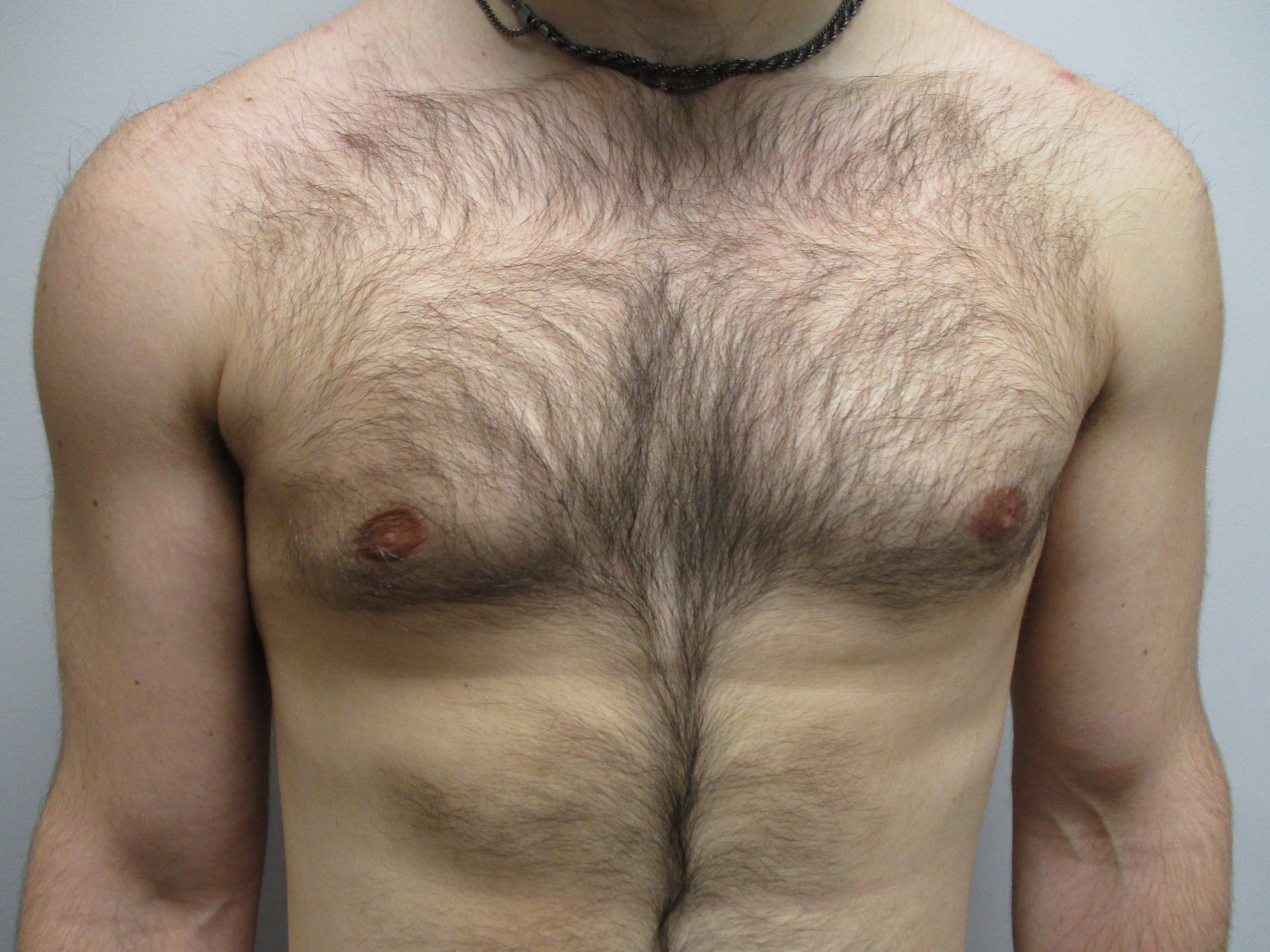 Gynecomastia before and after - after