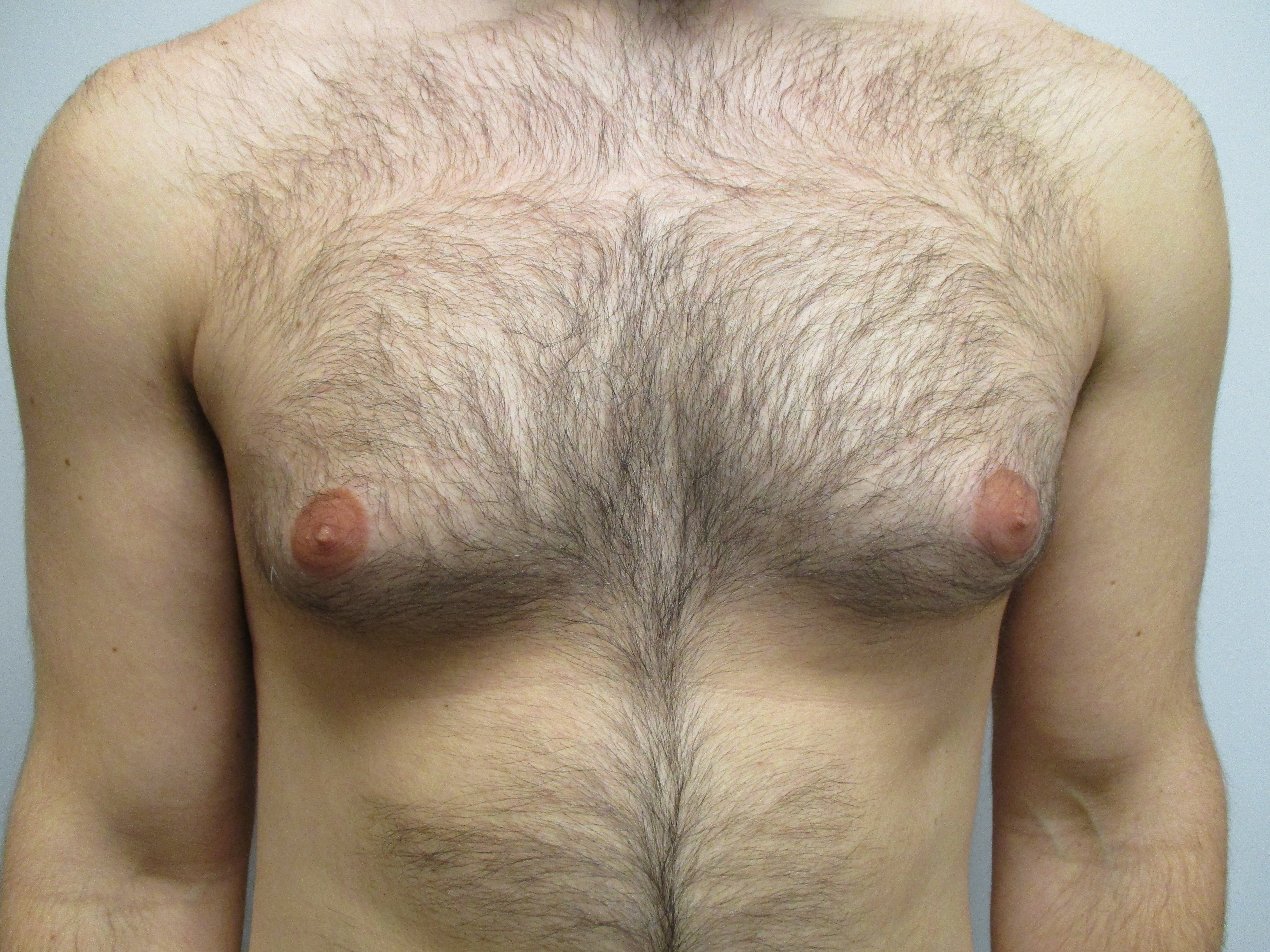 Gynecomastia before and after - before
