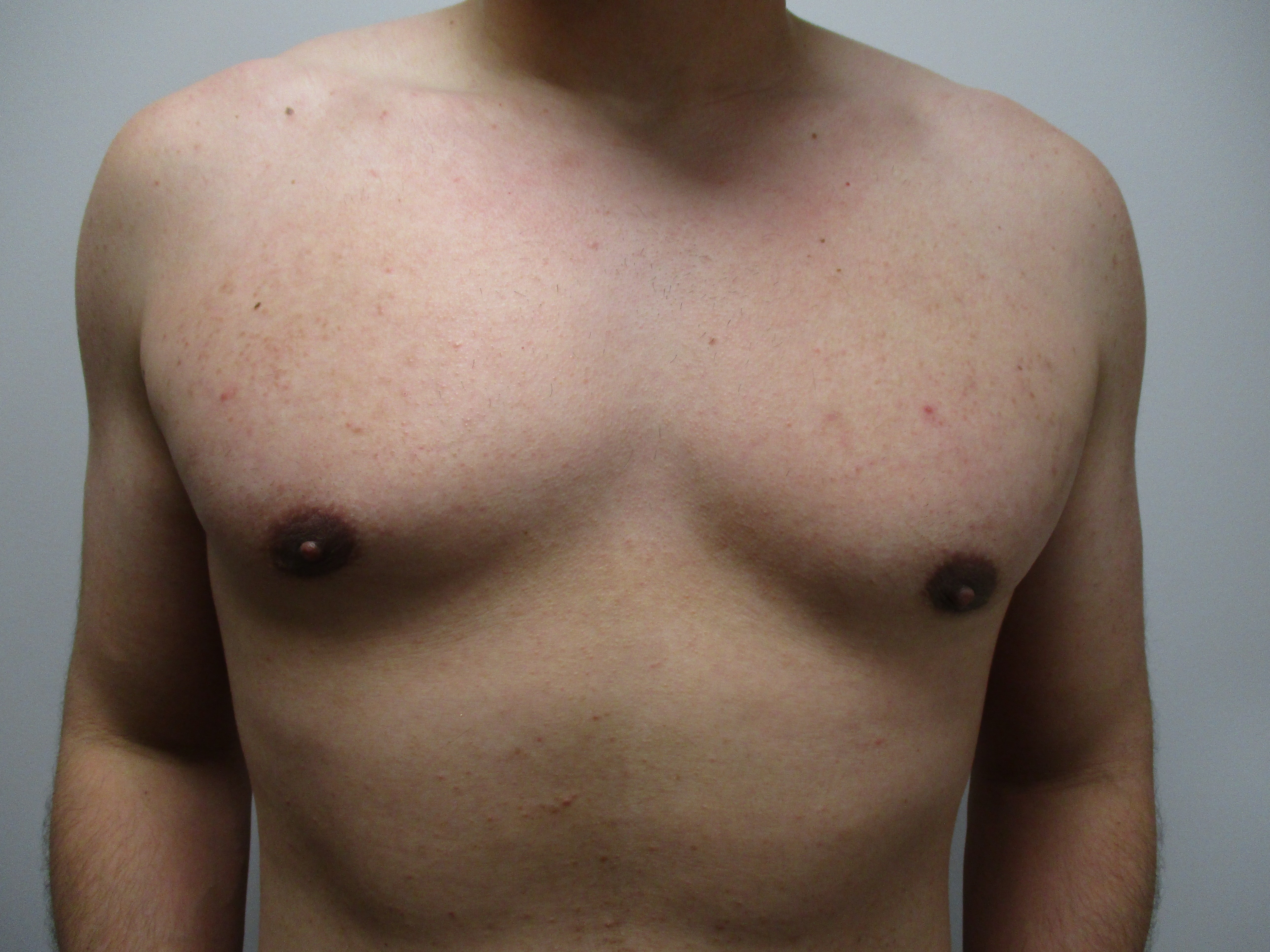 Gynecomastia before and after - after