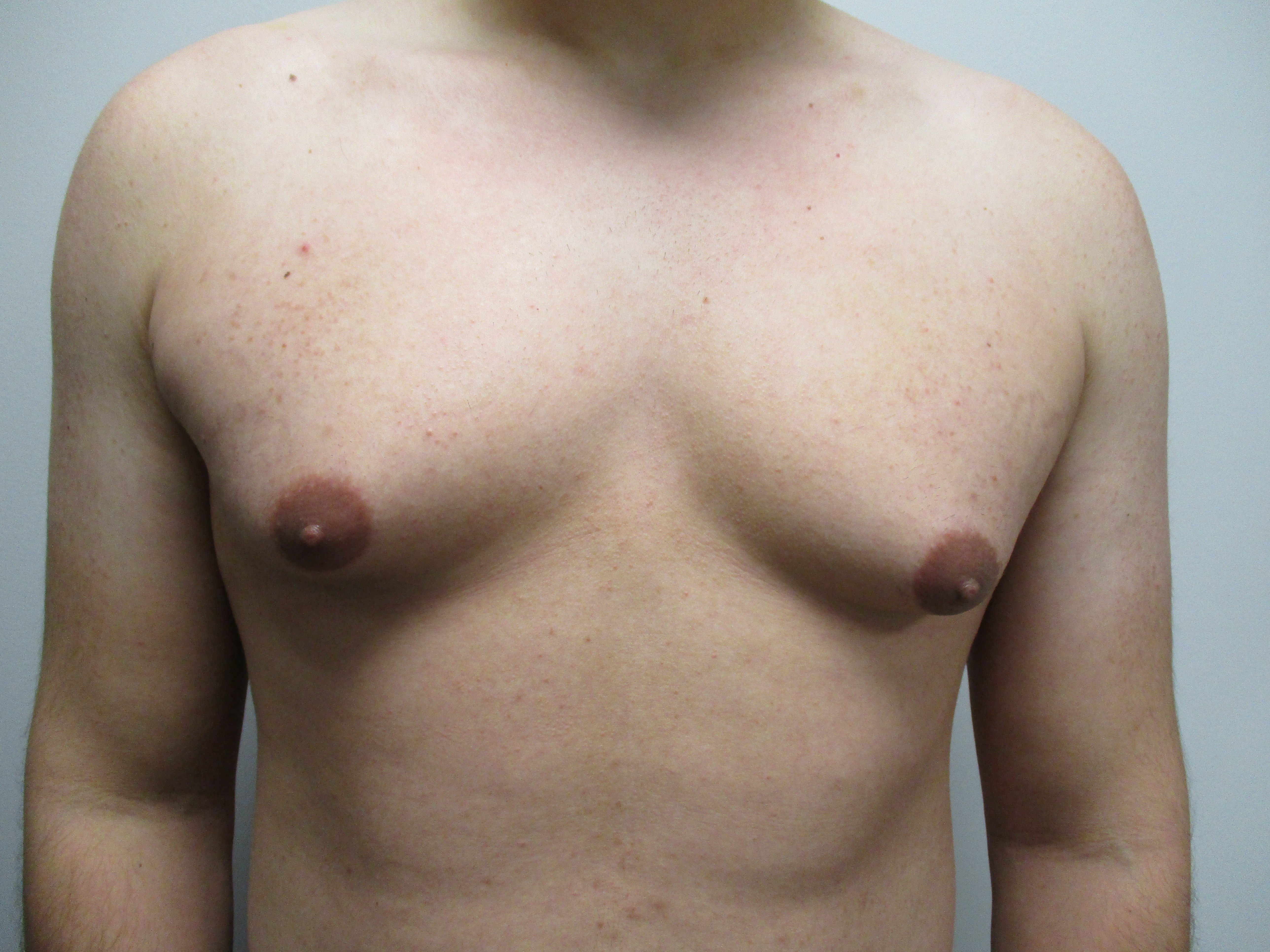 Gynecomastia before and after - before