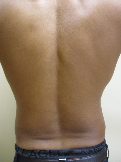 SmartLipo before and after - after