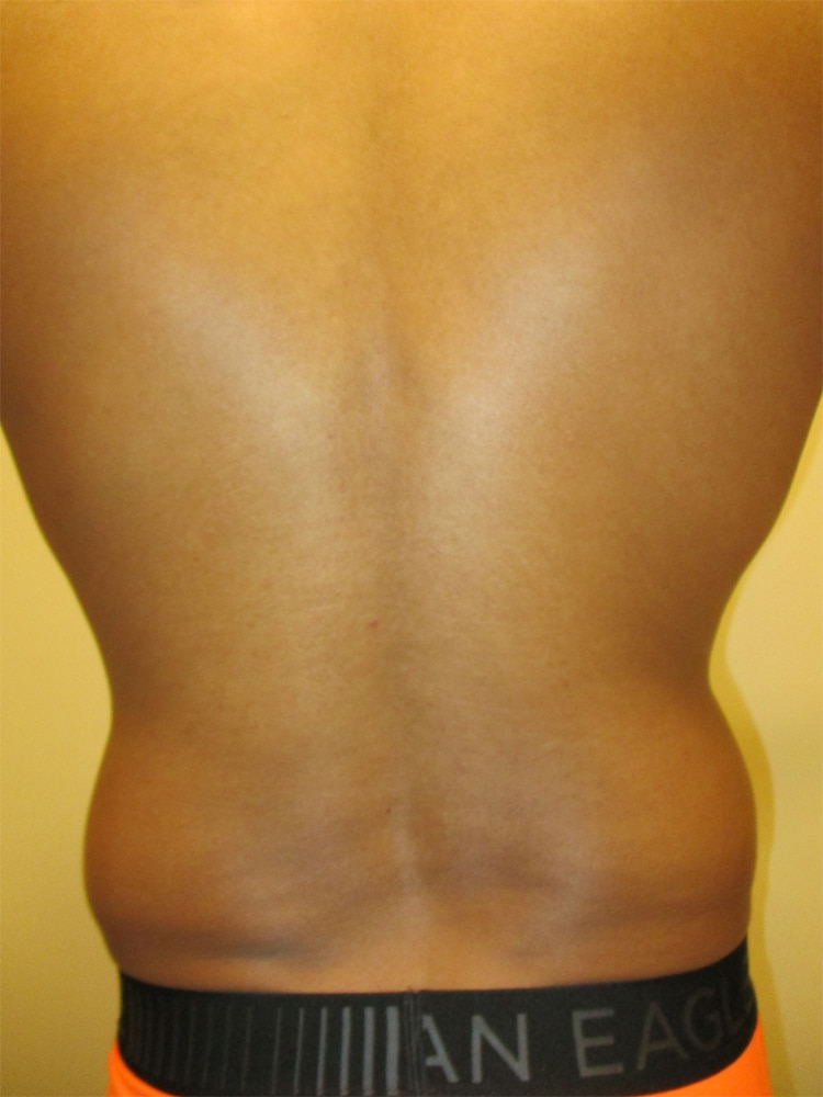 SmartLipo before and after - before