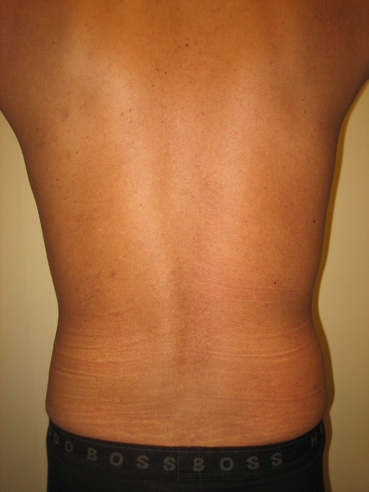 SmartLipo before and after - after