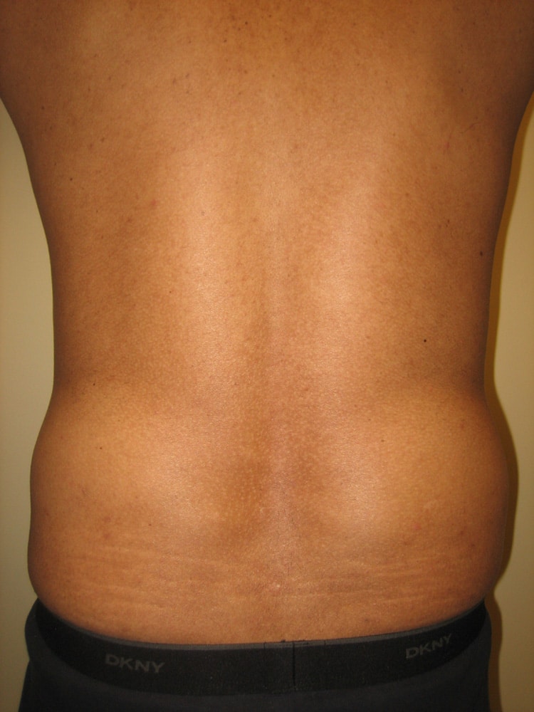 SmartLipo before and after - before