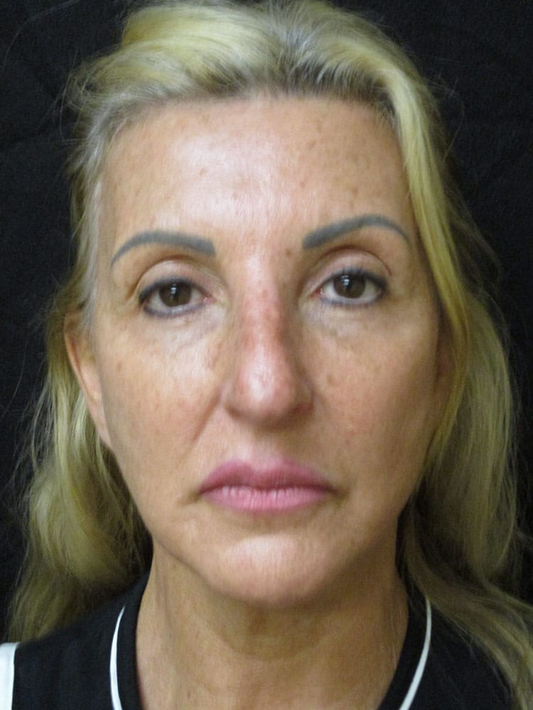 Facelift before and after - after