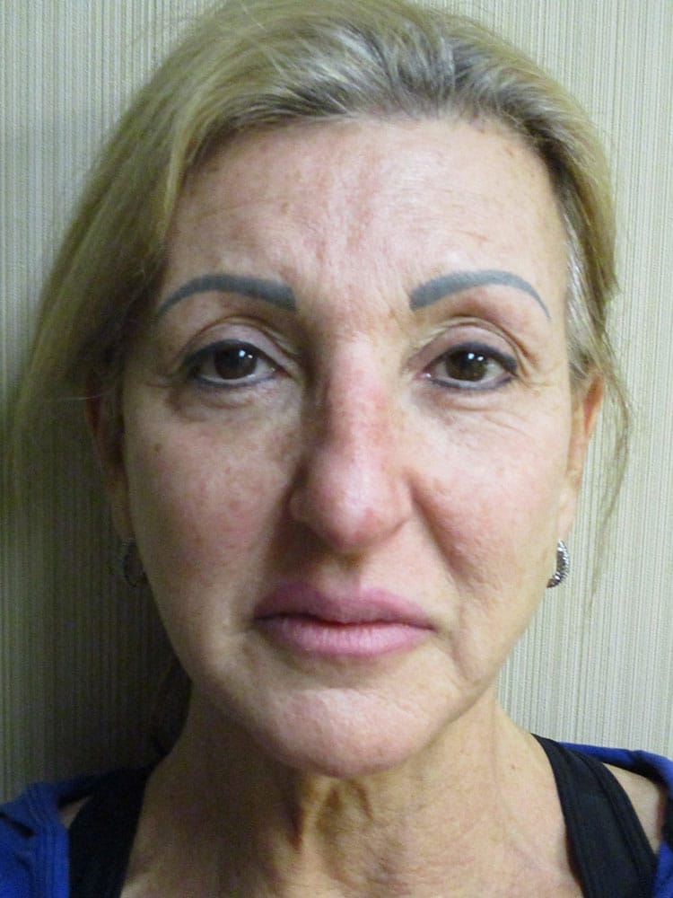 Facelift before and after - before