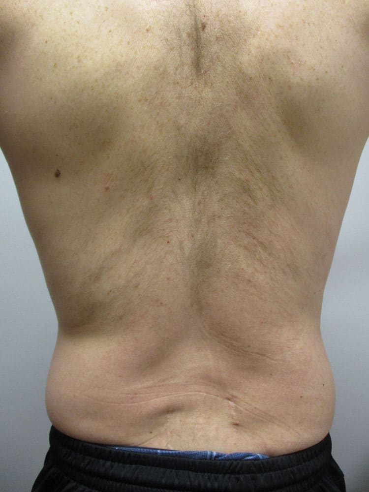 SmartLipo before and after - after