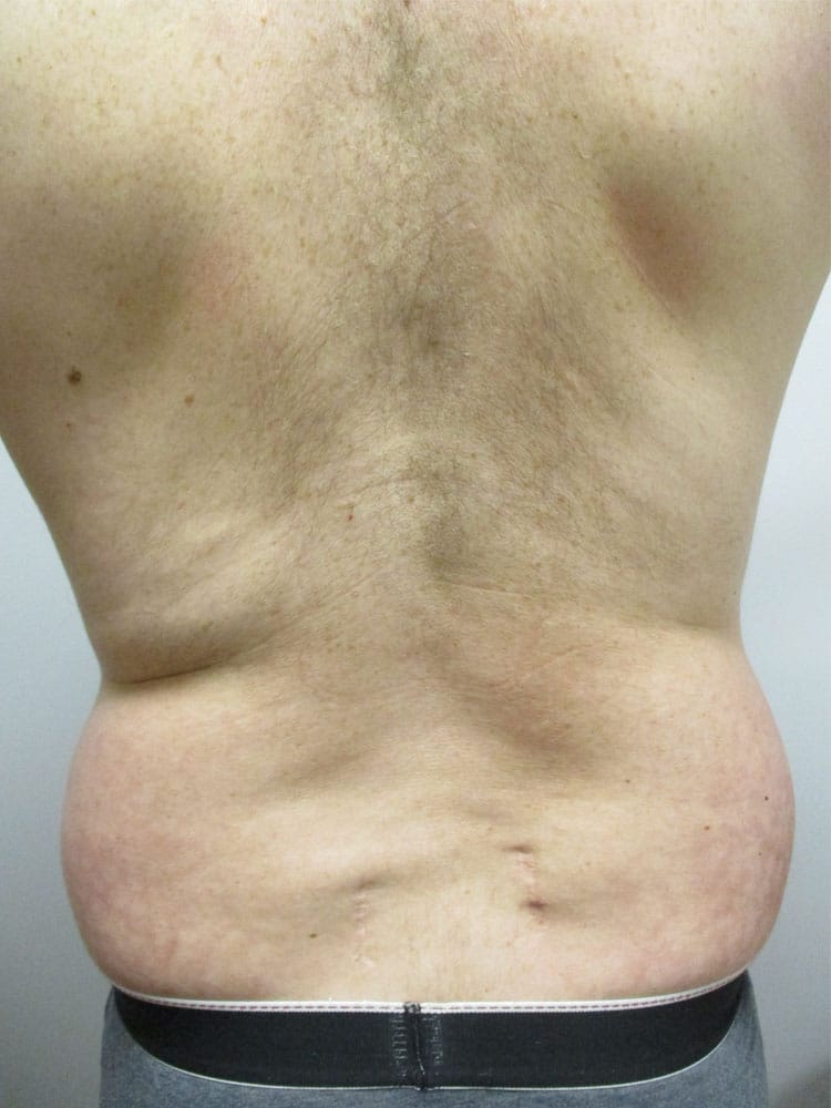 SmartLipo before and after - before