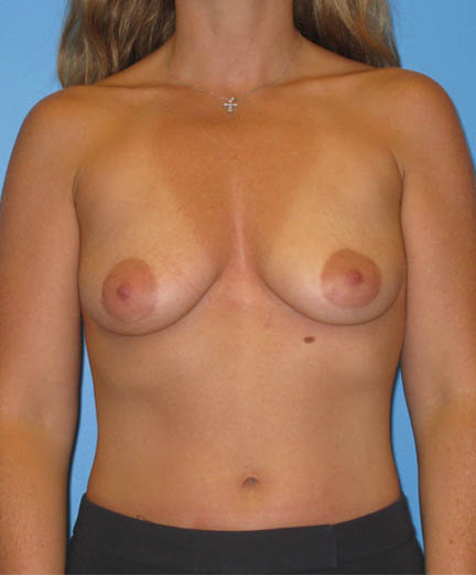 Breast Augmentation before and after - before