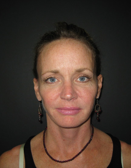 Facelift before and after - after