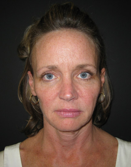 Facelift before and after - before