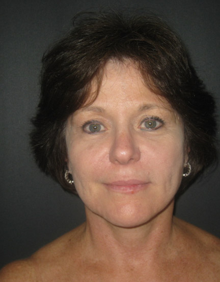 Facelift before and after - after