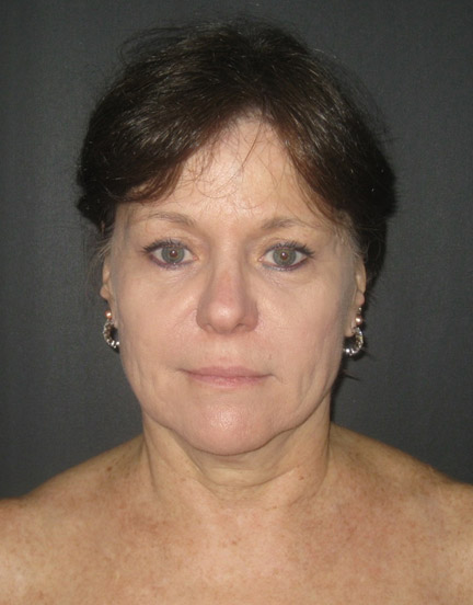 Facelift before and after - before