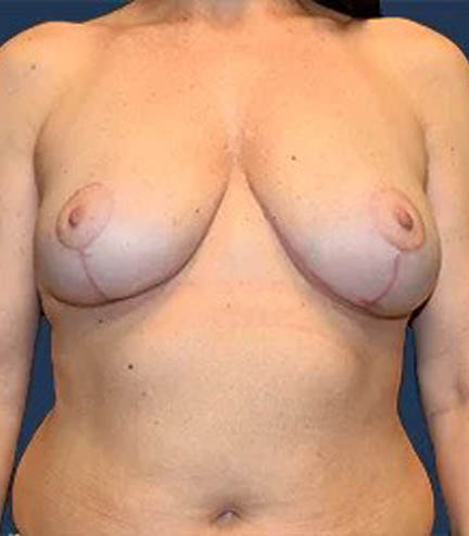 Breast Reduction before and after - after